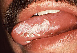 Лейкоплакия рта